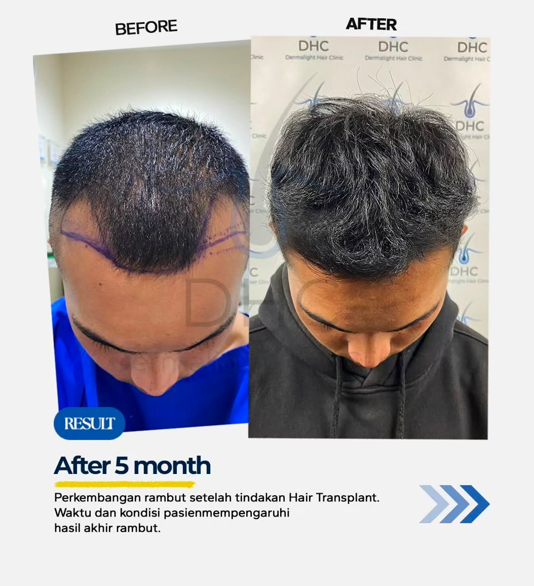 FUE Hair Transplant After