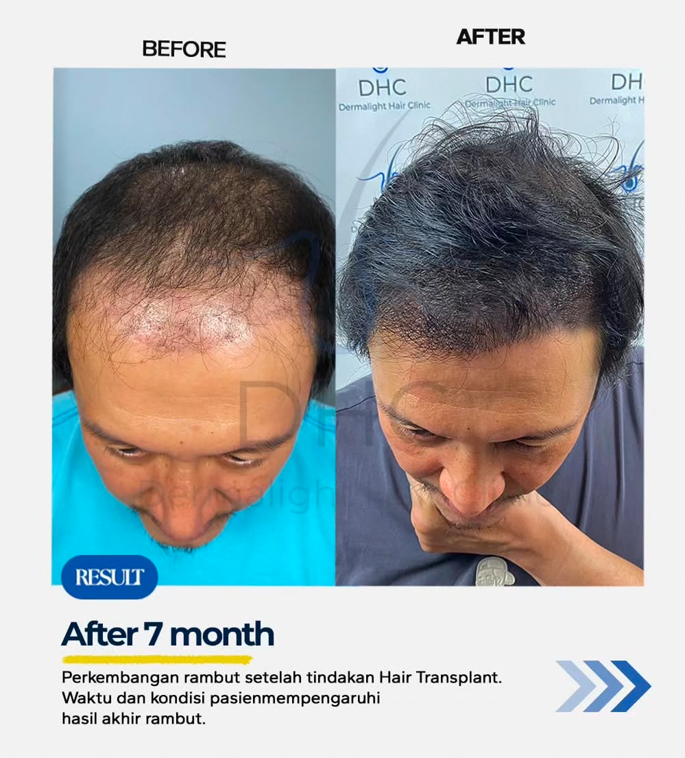 DHI Hair Transplant After