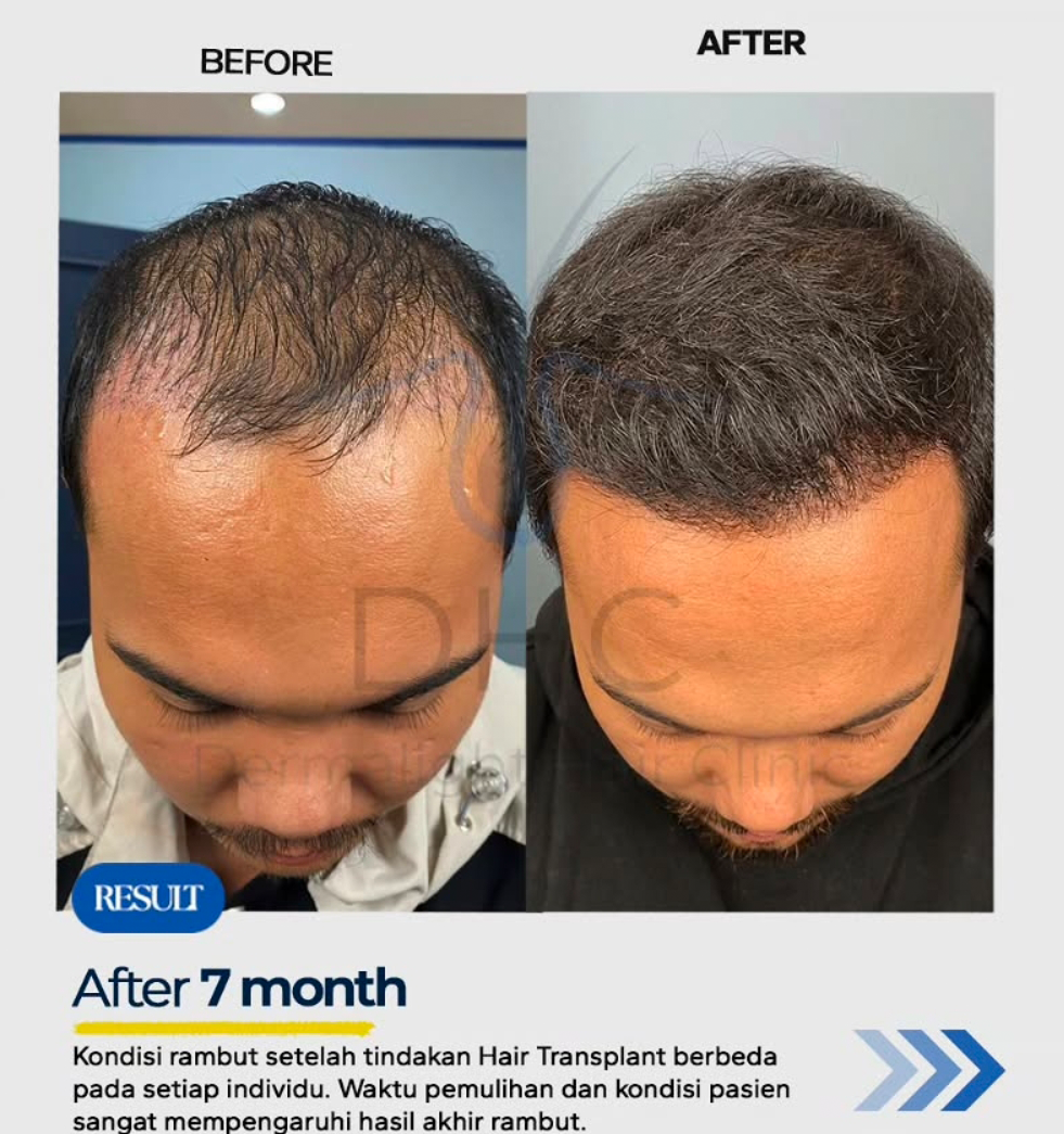 Hairline Restoration After
